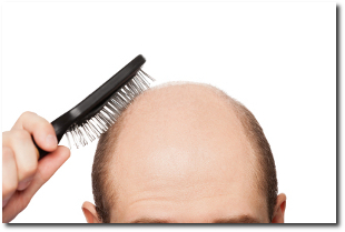 7 Stages of Balding